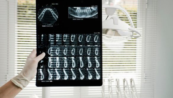 Radiografia dentară digitală captează imagini clare ale zonelor osoase şi a țesuturile profunde