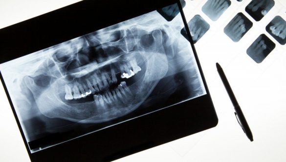 De ce este radiografia dentară o parte esențială a consultației la YTS Dental View?