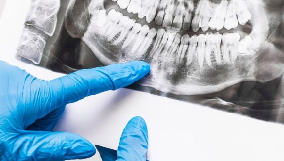 Ce se poate vedea cu ajutorul tomografiei dentare?