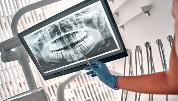 RAZELE X DENTARE: SUNT JUSTIFICATE MOTIVELE DE ÎNGRIJORARE LEGATE DE EXPUNEREA LA IRADIERE?