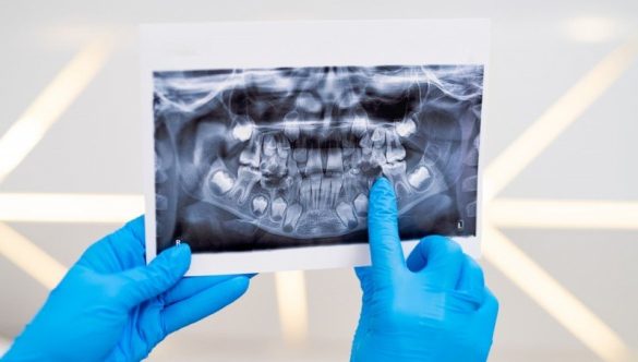 De ce este importantă repetarea periodica a radiografiilor dentare?Explicații de la specialiștii YTS