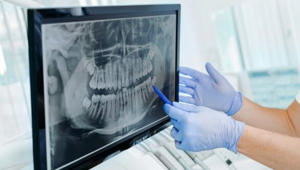 RADIOGRAFIA DENTARĂ DIGITALĂ: PROCEDURĂ NEDUREROASĂ, IRADIERE SCĂZUTĂ, TIMP SCURT