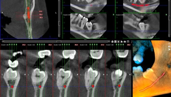 TOMOGRAFIE DENTARĂ ÎN SCOP ENDODONTIC