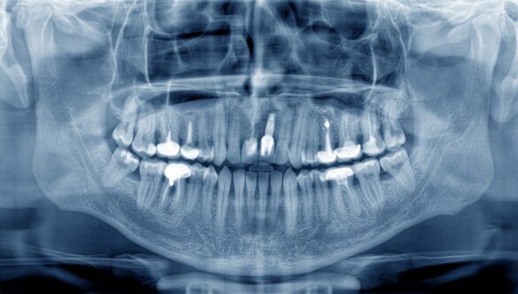 CUM POATE FI ELIMINATĂ SPAIMA DE CABINETUL DENTAR PRINTR-O RADIOGRAFIE DENTARĂ PANORAMICĂ?