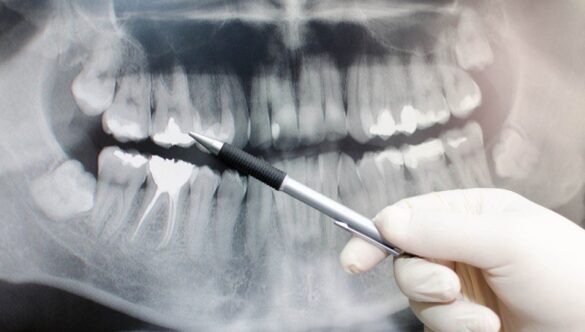 TOTUL DESPRE RADIOGRAFIA DENTARĂ
