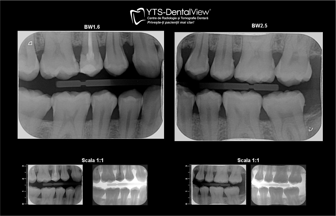 radiografie-bitewing