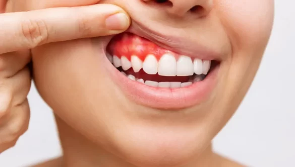 Tomografia CBCT  esentiala in diagnosticul si tratamentul paradontozei